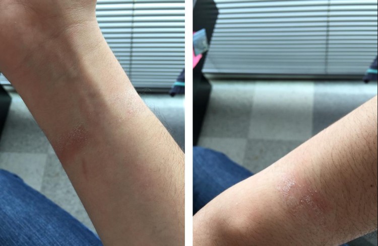 Владельцы Apple Watch жалуются на аллергию и покраснения кожи.